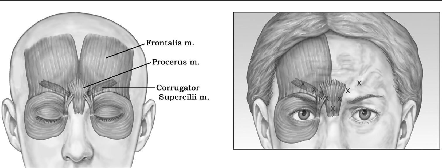 Corrugator supercilii